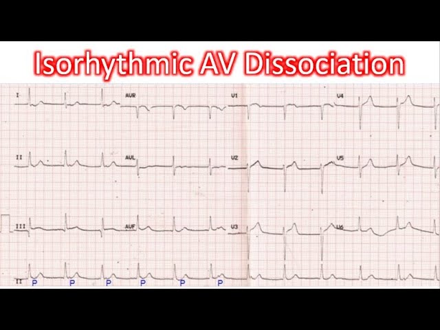 Isorhythmic AV Dissociation