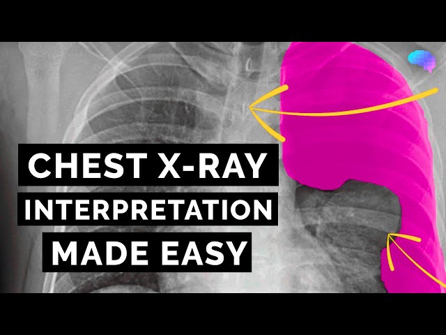 Chest X-ray Interpretation | How to Read a CXR | OSCE Guide | UKMLA | CPSA | PLAB 2