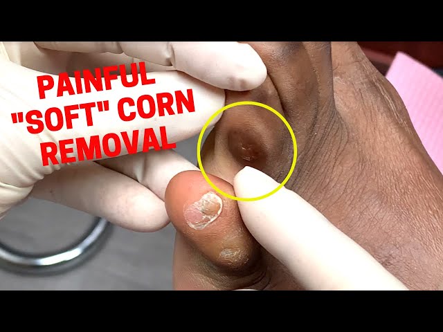 PAINFUL "SOFT" CORN REMOVAL