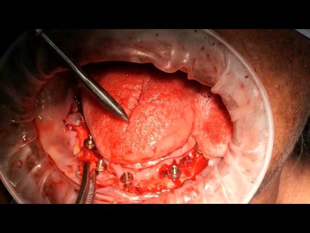 part 2 - all on 5 with bioline SMU implants for atrophic mandible, surgery procedure, chennai, india