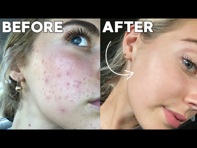 How I Cleared My Skin In 8 Weeks *naturally*