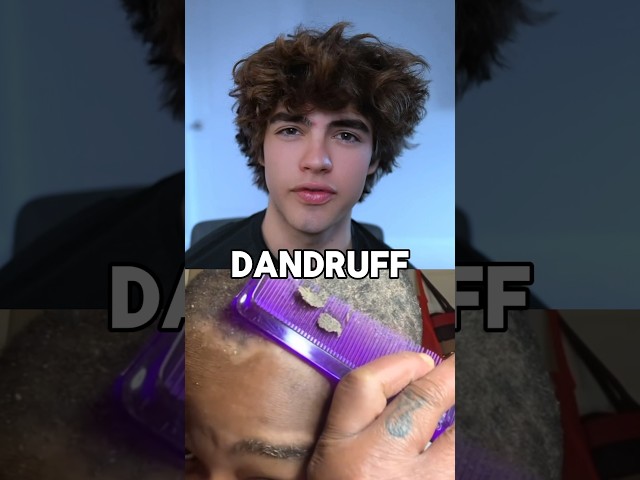 How to get rid of dandruff 😱