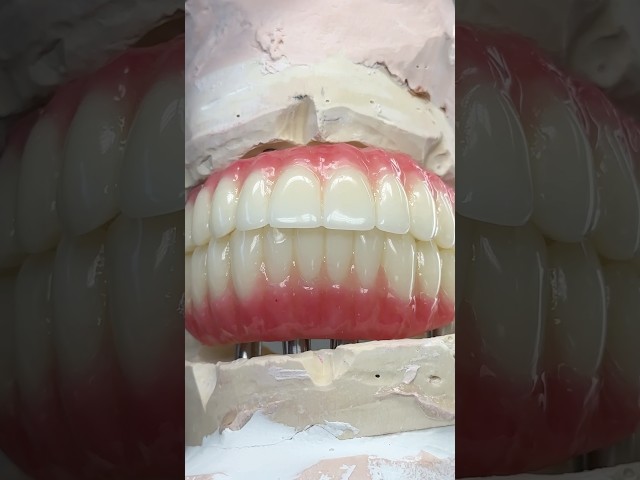 Full Mouth PMMA Provisionals #lsk121shorts #dental #teeth