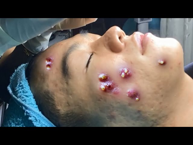 Big Cystic Acne Blackheads Extraction Blackheads & Milia, Whiteheads Removal Pimple Popping #087