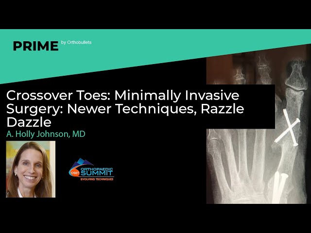 Crossover Toes: Minimally Invasive Surgery: Newer Techniques, Razzle Dazzle - A. Holly Johnson, MD