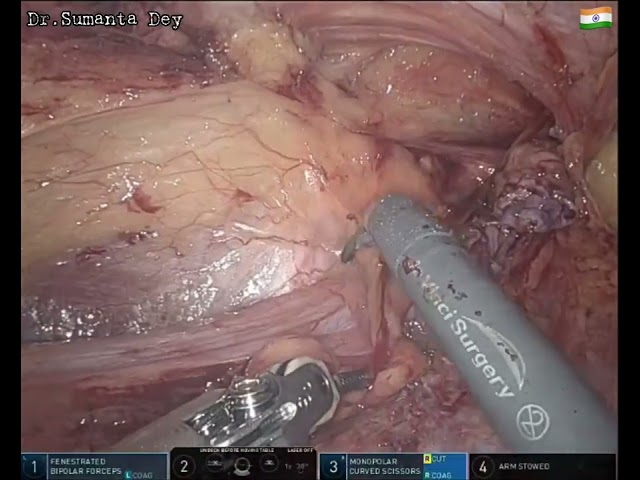 rTAPP Indirect InguinoScrotal Hernia: DaVinci X Robot by Dr.Sumanta Dey