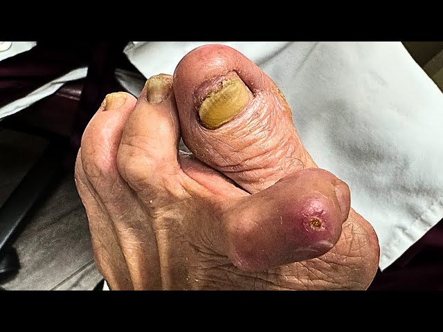 Ulcer Debridement and Extreme Nail Cutting On a 94-Year-Old Patient's Deformed Toe!