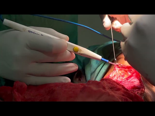 PMMC FLAP SURGICAL TIPS I Dr Manish Tiwari | oral surgery lectures