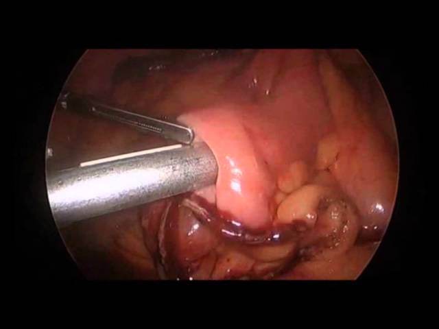 Laparoscopic Intra Corporeal Anastomotic Technique by Dr. Iraniha