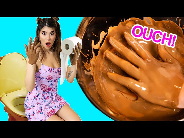 Meet The Girl With Chocolate For Hands (True Reality Story)