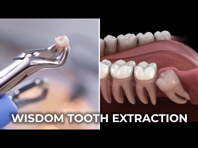 Wisdom Tooth Extraction | عقل داڈ نکالنا | The Complete Guide to Wisdom Tooth Extraction