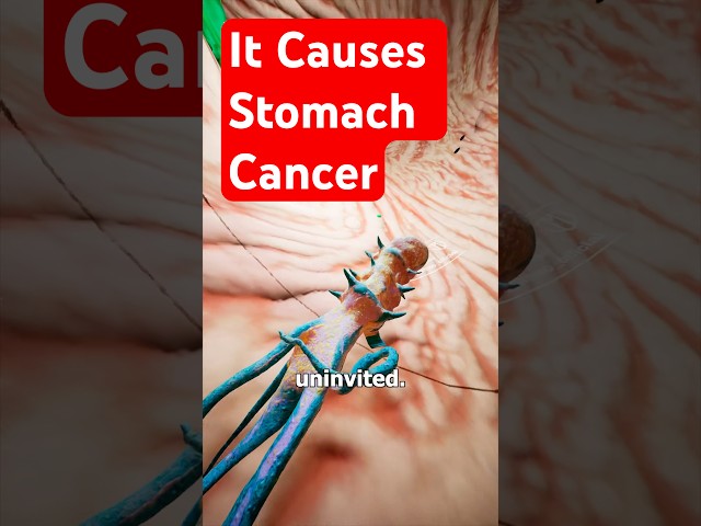 Stomach Cancer 🦠  H Pylori Explained