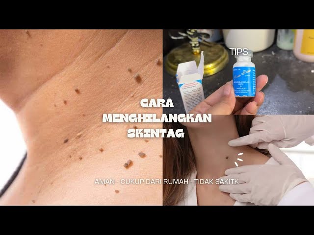 Cara Menghilangkan Skintag / Kutil / Daging tumbuh diatas kulitdengan MUDAH ‼️