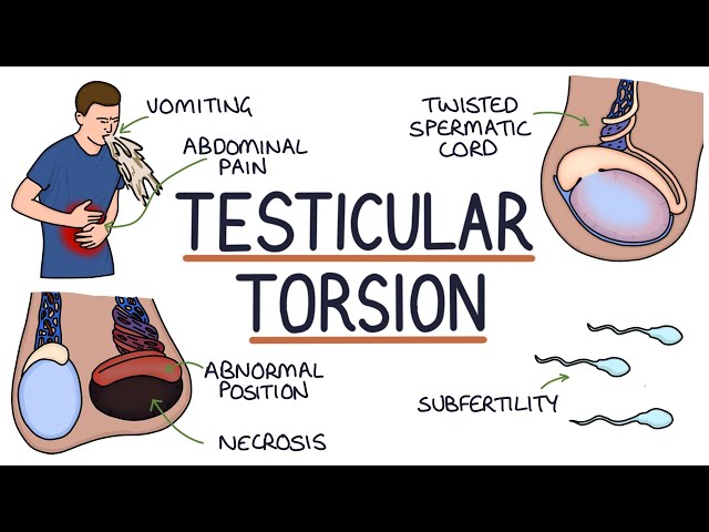 Understanding Testicular Torsion