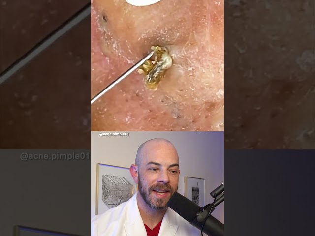 Derm reacts to massive blackhead removal! #dermreacts #doctorreacts #blackheadextraction