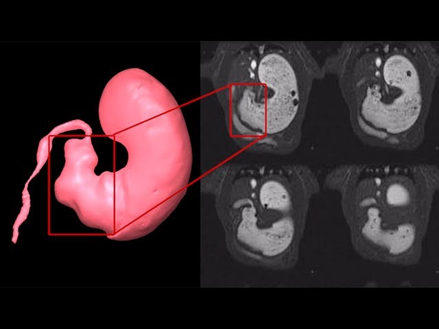 MRI shows how stimulation helps digestive disorders