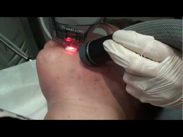 Fraxel: the Acne Scar laser treatment