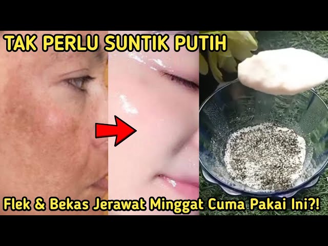 MURAH & AMPUH!! FLEK HITAM DAN BEKAS JERAWAT MINGGAT CUMA PAKAI INI?! CARA MEMUTIHKAN WAJAH PERMANEN