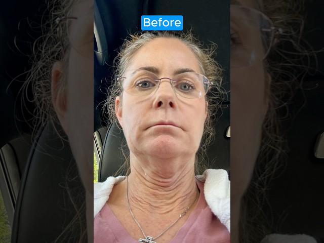 INCREDIBLE Facelift Transformation! NECK LIFT RESTORE