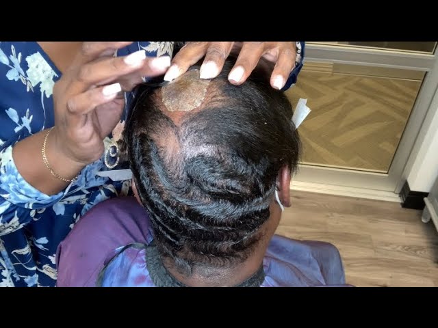 Covering a scarred Alopecia bald spot | Hair extensions for Alopecia