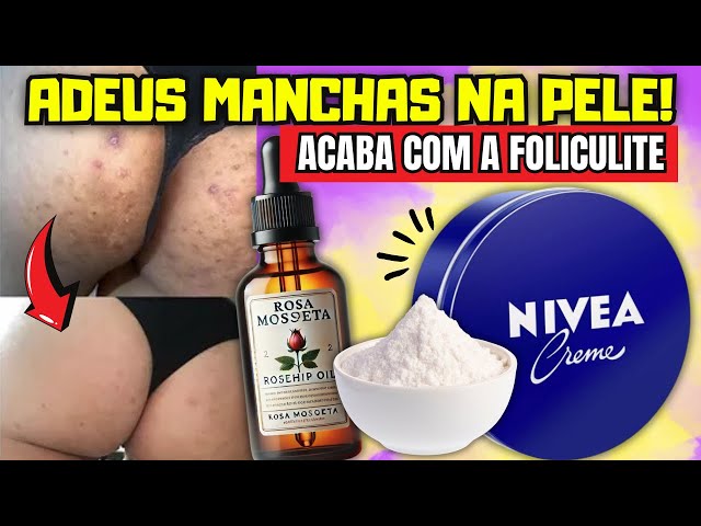 Use para CLAREAR qualquer MANCHA DE PELE ! Melasma , Manchas nas Axilas e Virilhas