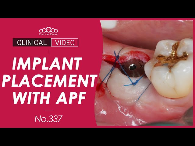 #47 Implant placement with apically positioned flap - [Dr. Cho Yongseok]