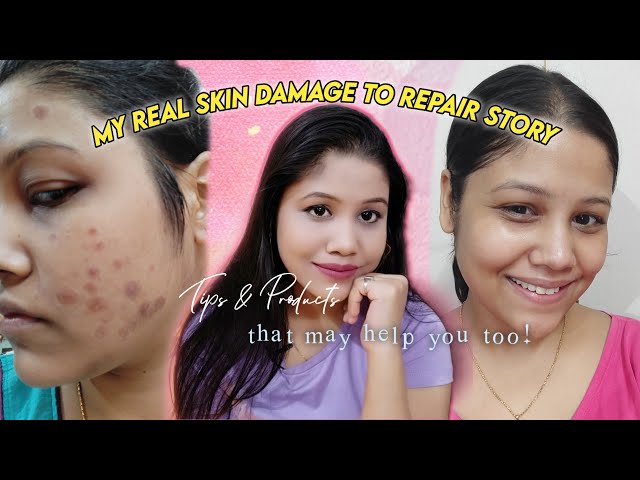 My real skin DAMAGE to REPAIR story | How I cleared my skin  - Tips & Products that helped