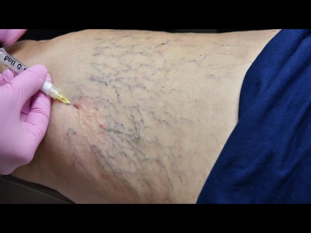 Allure Vein Center: Sclerotherapy Spider Vein Treatment