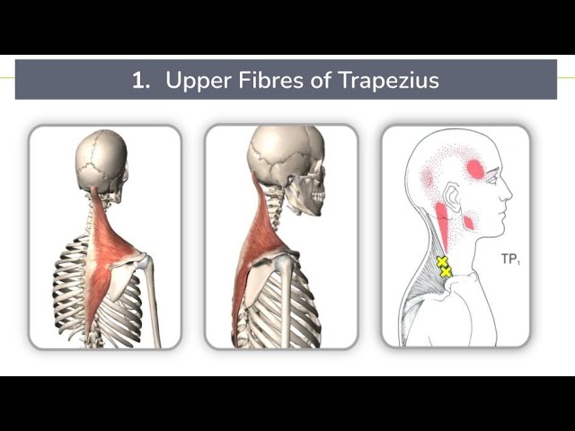 Which Neck Muscles can cause Head Pain? | Webinar Excerpt | Easthill Physiotherapy