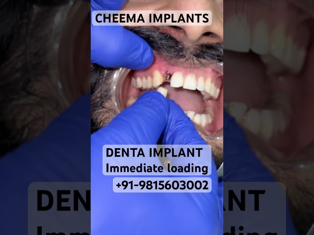 Front Upper teeth Incisor dental implant procedure surgery accident broken root canal Jalandhar PB