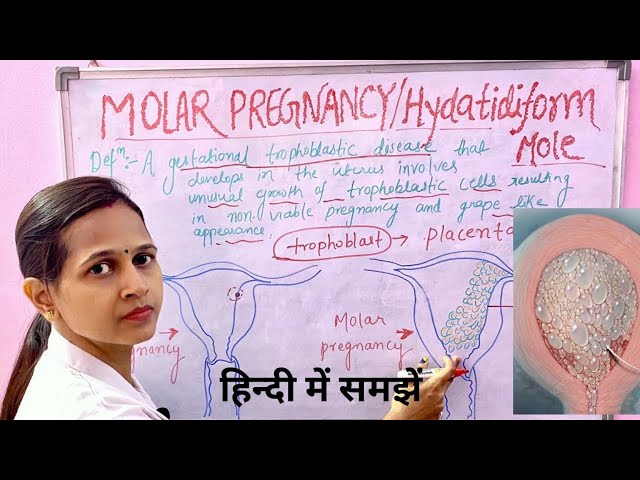 Molar Pregnancy/ Hydatidiform Mole/Important for all nursing exams/असमान्य गर्भावस्था