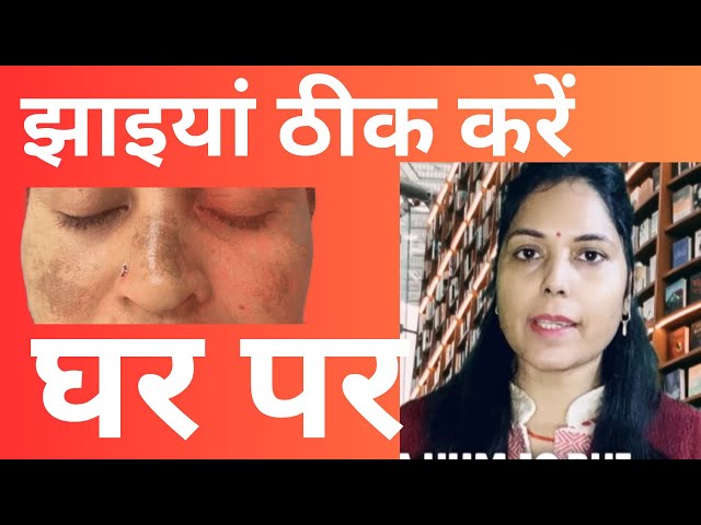 झाइयाँ ठीक करें घर पर/Pigmentation Treatment At Home/ Jhaiya hongi thik medicine ke bina/Yoga Arogya