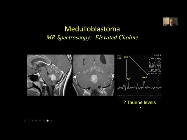 Neuroradiology of Medulloblastomas - Dr Suresh Mukherji MD MBA FACR & Dr Hemant Parmar MB BS