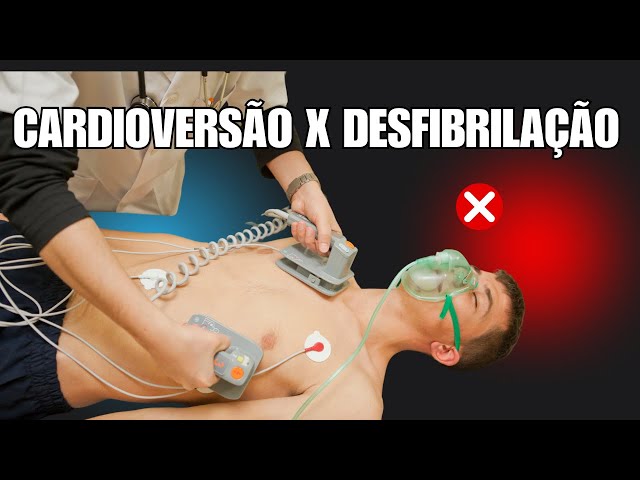 Cardioversão Elétrica Sincronizada ou Desfibrilação ? Como tratar uma taquiarritmia?