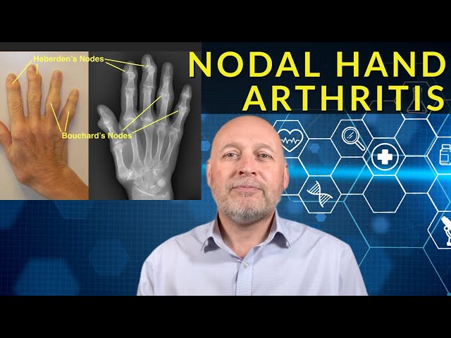 Hand & Finger Arthritis - The Very Best Self-Help Ideas