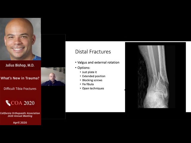 Difficult Tibia Fractures - Julius Bishop, MD