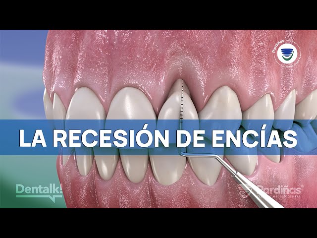 Causes and treatment of GUM RECESSION ©