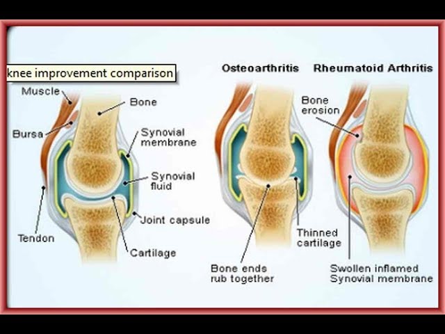 Joint  Supplement Relief For  Pain In Knees | Joint Advance -Over Counter