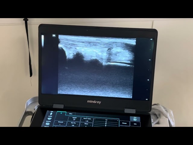 MSK ultrasound - Medial ankle   Tibialis posterior long axis