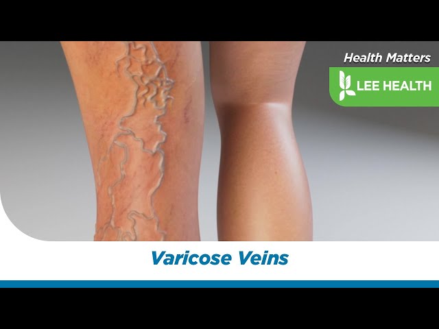 Varicose Veins