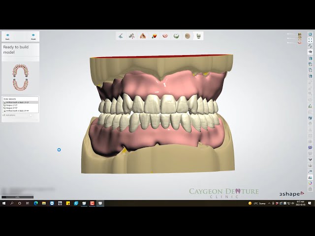 Complete Denture Design