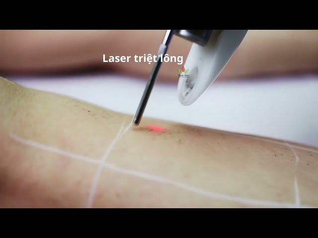 Một công nghệ triệt lông mới bằng Laser