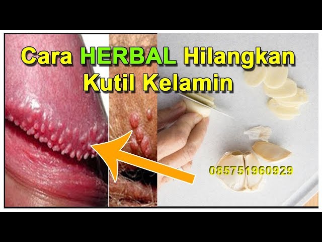 Cara Menghilangkan Kutil Secara Alami ( HERBAL )