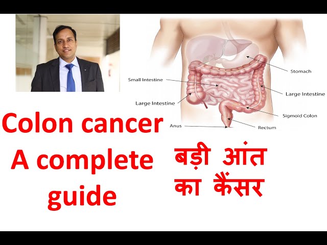 Colon cancer in Hindi. Large Bowel, large intestine cancer. Symptoms, treatment, Dr Vikas Singla.