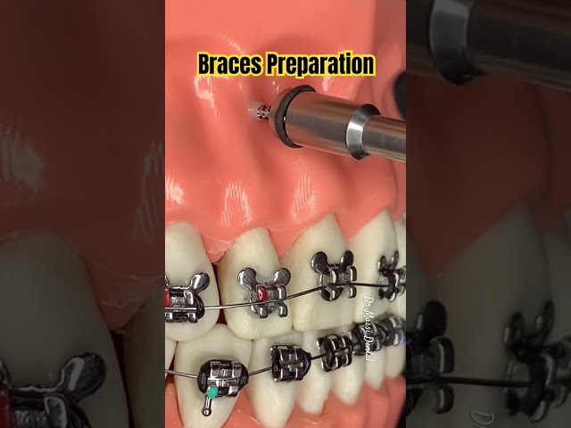 BRACES PREPARATION