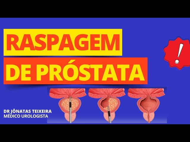 RTU DE PRÓSTATA (RASPAGEM): SAIBA AS VANTAGENS