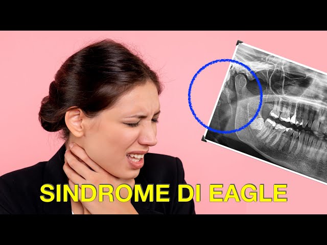 Sindrome di Eagle