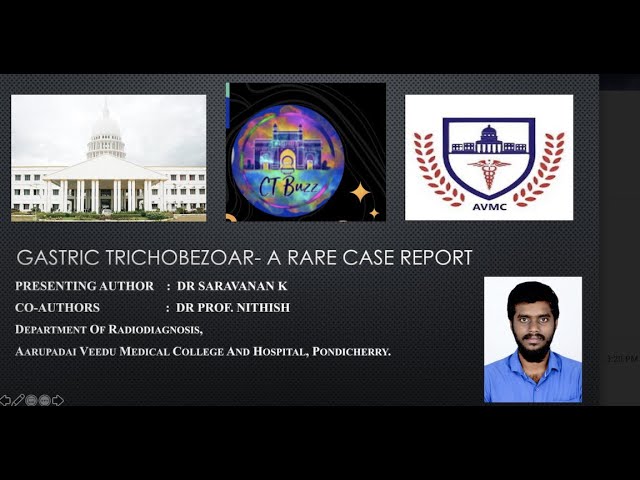 SARAVANAN K || TRICHOBEZOAR A CASE REPORT