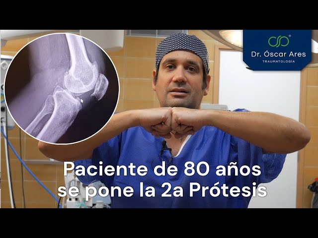 Paciente de 80 años se pone la segunda prótesis - Dr. Oscar Ares