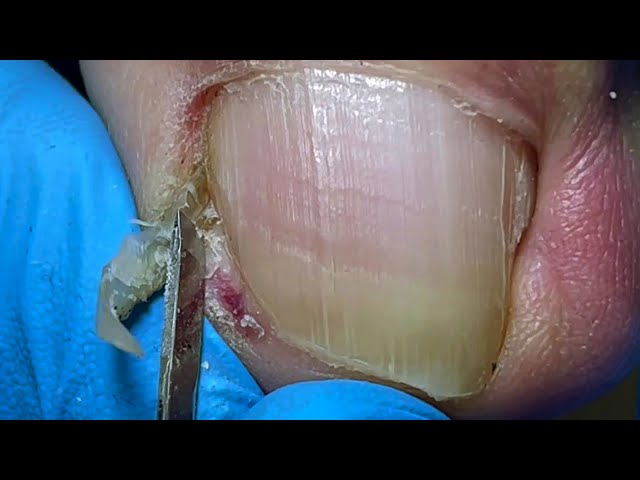 Repair nails with ingrown nails and relieve patients' troubles【Pedicure Master Lin Jun】